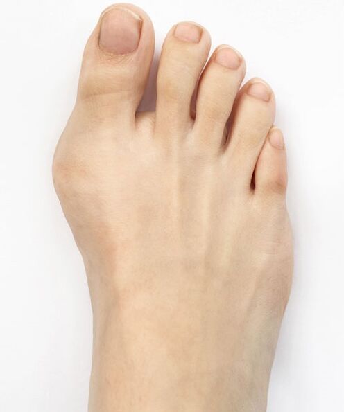 hallux valgus pred použitím spreja Hondro Sol Valgus