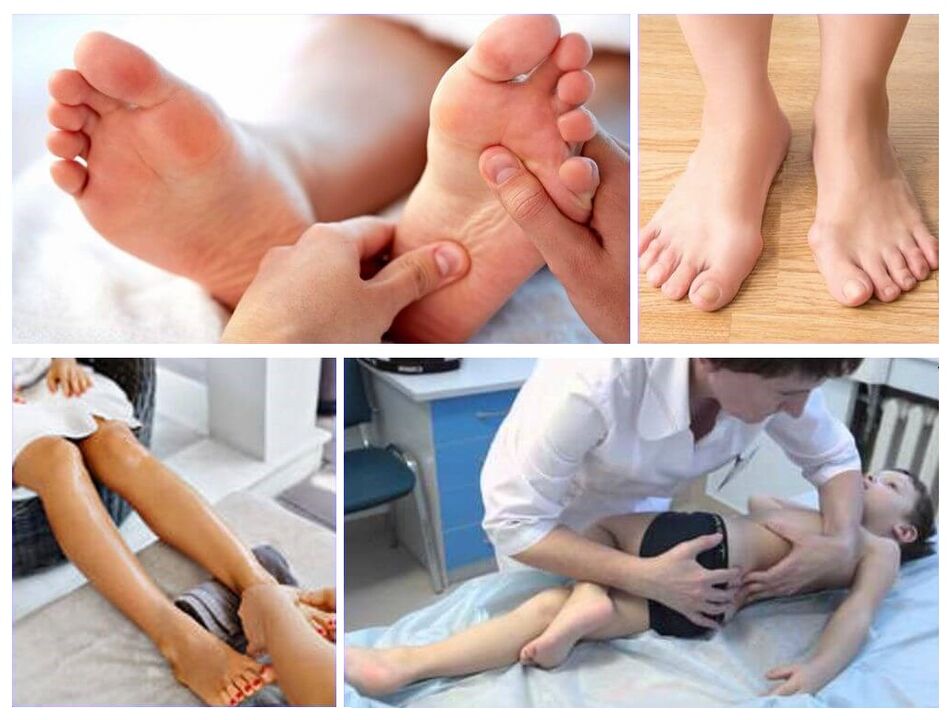 Deformácia Valgus pri liečbe detí