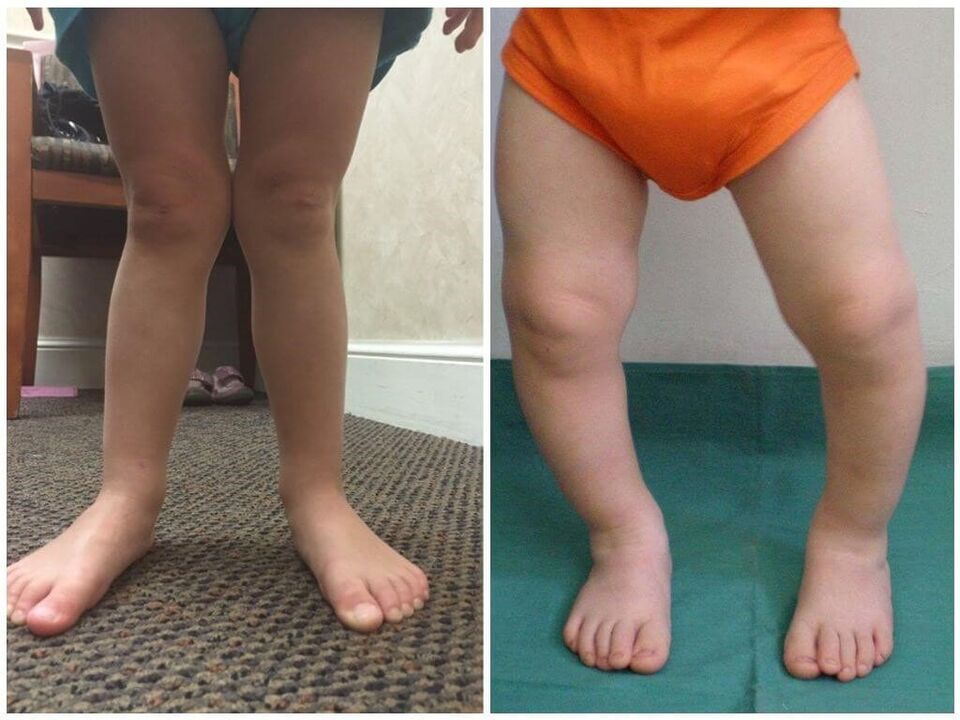 Deformácia Valgus u detí spôsobuje