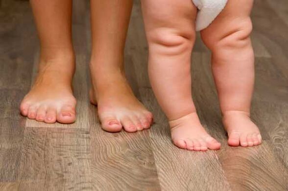 Deformácia Valgus u detí