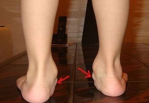 Deformácia nôh Valgus u detí