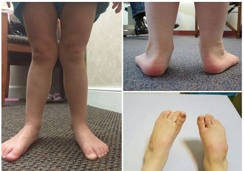 Deformácia Valgus u detí