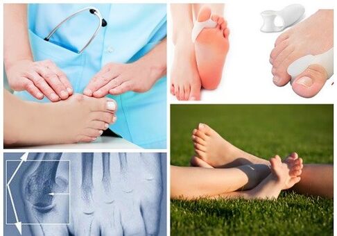 Ošetrenie deformácie Valgus