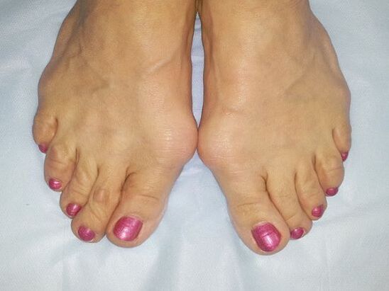 Hallux Valgus Deformita nôh
