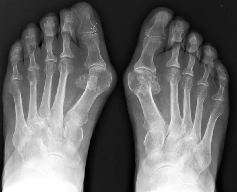 Röntgenový snímok hallux valgus